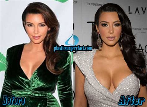 Kim Kardashian Plastic Surgery Before and After Photos
