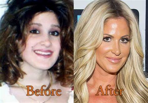 Kim Zolciak Plastic Surgery Before and After ...