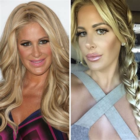 Kim Zolciak Plastic Surgery Before And After Pictures ...