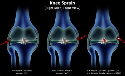 Knee Buckling: What Can Cause Knees To Buckle?