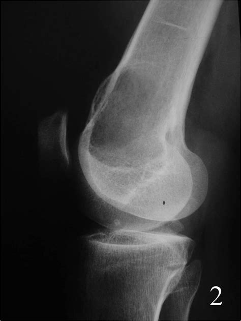 Knee Cancer X Ray Pictures to Pin on Pinterest   ThePinsta