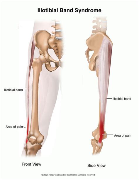 Knee lateral collateral ligament pain   New Doctor Insights