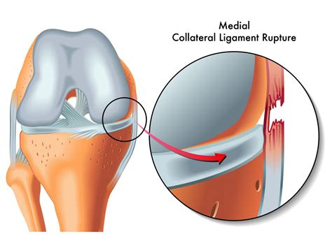 Knee Ligament Injuries Singapore | Tears in ACL, MCL & PCL