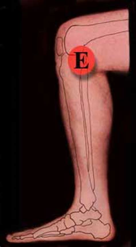 Knee Treatment Inside Right Leg
