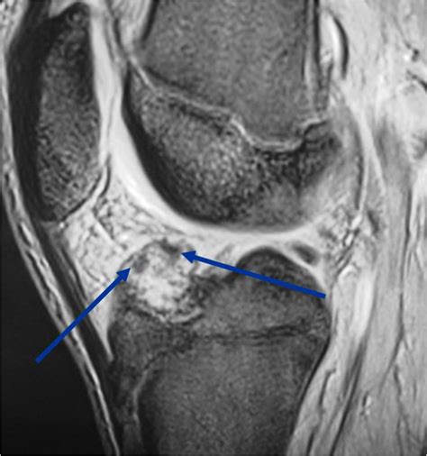 Knee Tumor Related Keywords   Knee Tumor Long Tail ...