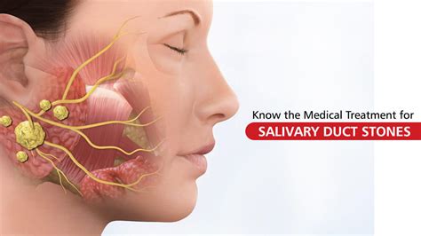 Know the Medical Treatment for Salivary Duct Stones