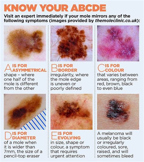 Know Your ABCDE of skin cancer | Skin Cancer | Pinterest