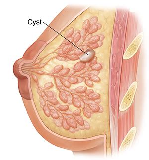 Krames Online Understanding Breast Cysts