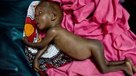 La desnutrición infantil en África