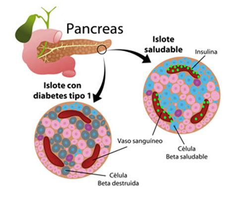 La Diabetes | Revista Diabetes