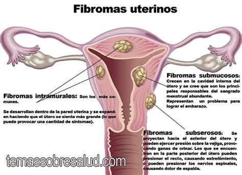 La diferencia entre los fibromas y pólipos