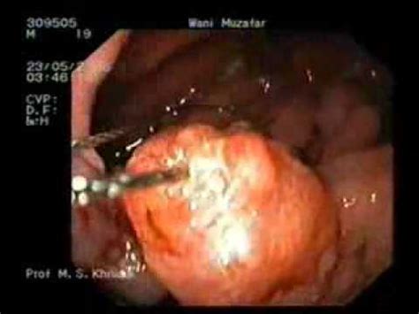 La eliminación de múltiples tumores en el estómago   YouTube