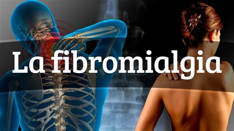 La fibromialgia   Causas, síntomas y tratamiento   YouTube