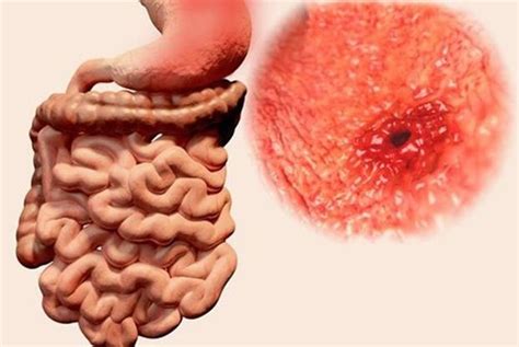 ¿La gastritis puede causar cáncer de estómago?