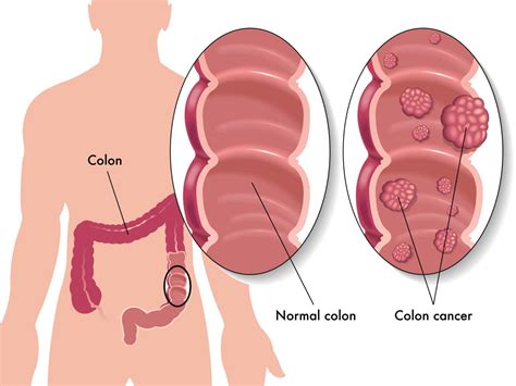 La importancia de la detección precoz de cáncer de colon y ...