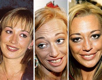 La nariz de Belén Esteban: antes y después