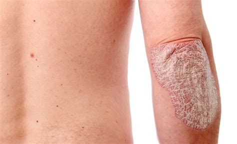 La Psoriasis  enfermedad de la piel