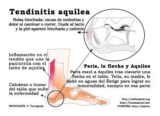 La tendinitis del talon de Aquiles   Pedro Torregrosa ...