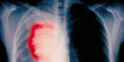 La terapia del cáncer de pulmón busca suprimir la ...