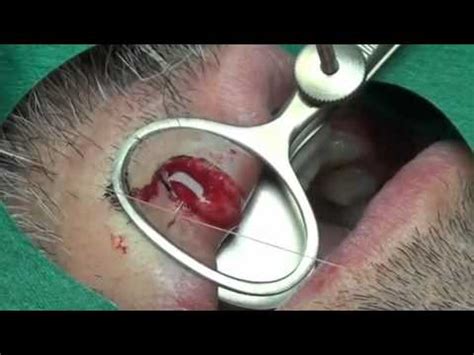 Labial Biopsy Spinous cell carcinoma   YouTube