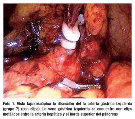 Laparoscopic distal gastrectomy for gastric cancer ...