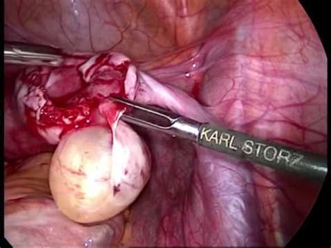 laparoscopic ovarian cystectomy for right dermoid cyst ...