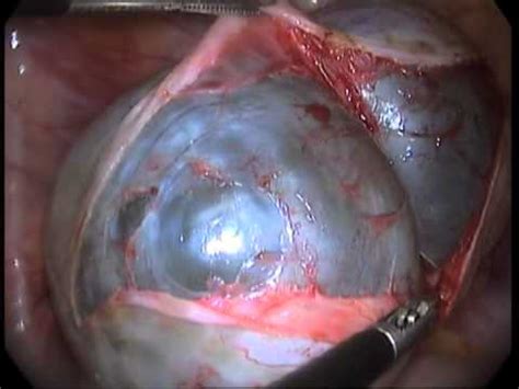 Laparoscopic Ovarian Cystectomy For Simple Ovarian Cyst Of ...