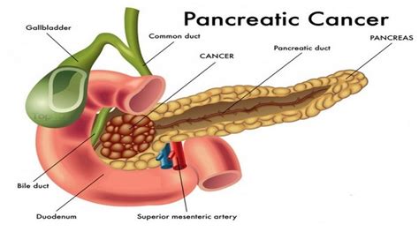 Laparoscopic Pancreatic Cancer Surgery kerala | Pancreatic ...