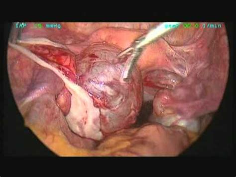 Laparoscopic Removal of Bilateral Ovarian Tumors • Video ...