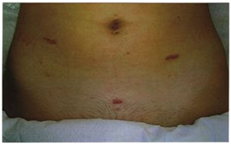 Laparoscopy Keyhole Surgery: Endometriosis, Ovarian Cysts ...