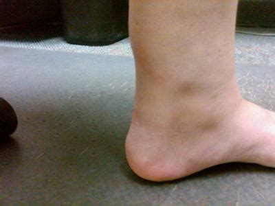 Large knot on achilles tendon, painful lumps on top and ...