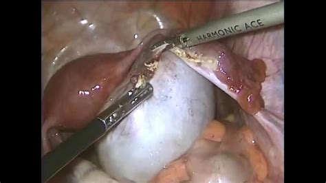 Large Ovarian Cyst  10cm    Laparoscopic Ovariotomy   YouTube