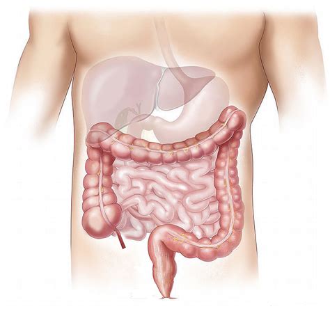 Las enfermedades más comunes del intestino grueso ...