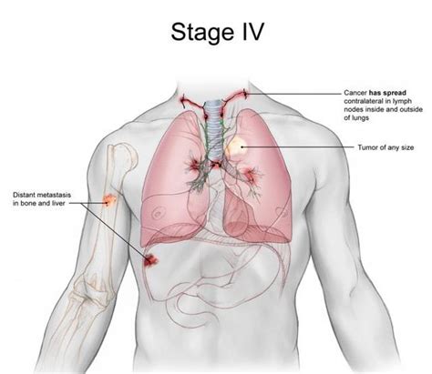 Last Stage Lung Cancer: Sign, Treatment and Life ...