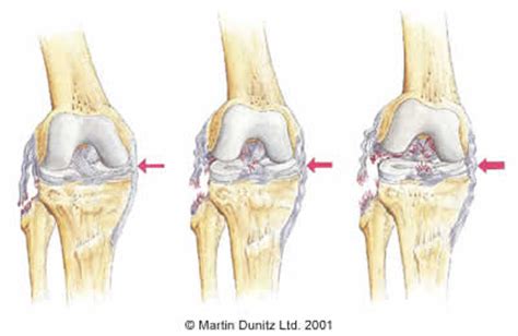 Lateral collateral ligament  LCL  injury. Causes, symptoms ...