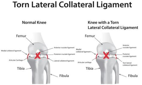 Lateral Collateral Ligament | tenderness.co