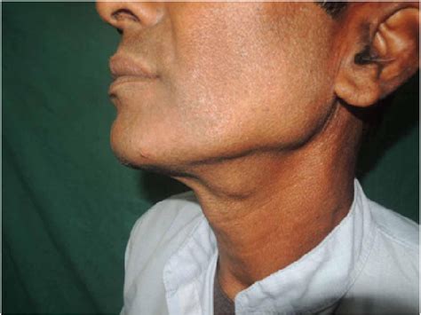 Lateral view of the left side of neck showing swelling in ...