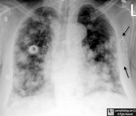 LearningRadiology   Pulmonary, Lung, Metastases, metastasis