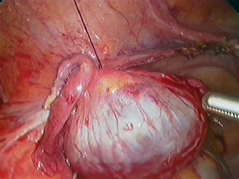 Left Ovarian Cyst Laparoscopic Oophorectomy