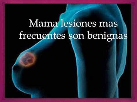 Lesiones benignas en las mamas ~ Virgina Consumer Voices