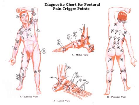 lesspacuthong: fibromyalgia pressure points diagram
