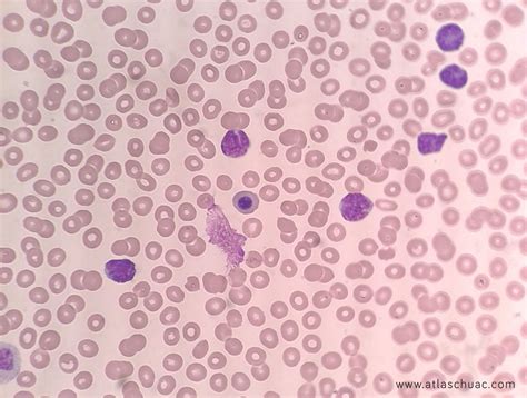 Leucemia aguda linfocítica  LAL  – Atlas CHUAC