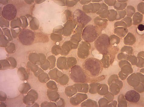 Leucemia de células dendríticas blásticas plasmocitoides