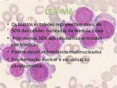 Leucemia Mieloblastica Aguda