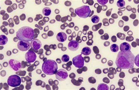 Leucemia mieloide cronica: cambiano in meglio aspettative ...