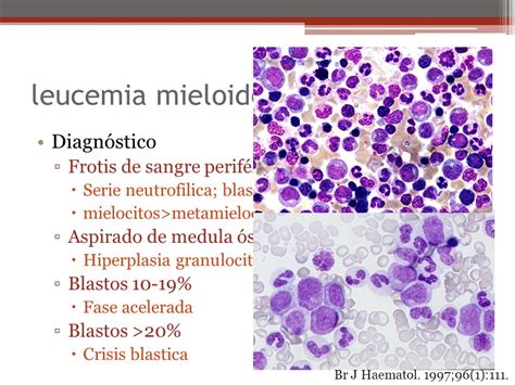 leucemia mieloide crónica   ppt video online descargar