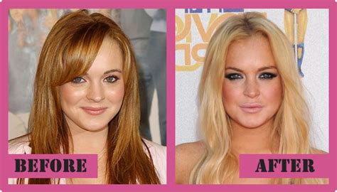 Lindsay Lohan’s Before and After Plastic surgery Photos ...