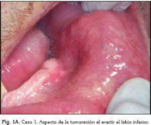 Linfangioma Cavidad Oral