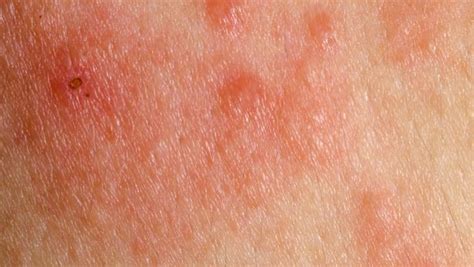 Linfoma cutáneo, un cáncer de piel poco común ...