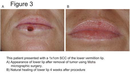 Lip Cancer: Not Uncommon, Often Overlooked   SkinCancer.org